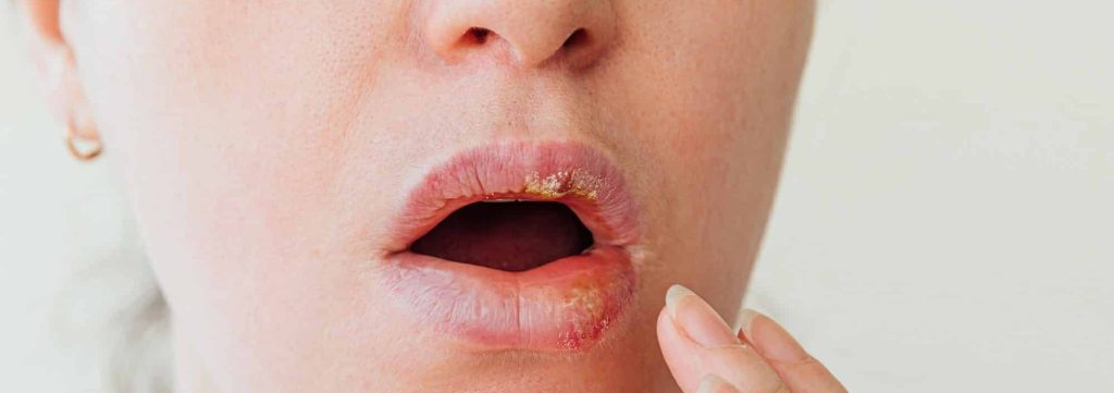 Herpes oral